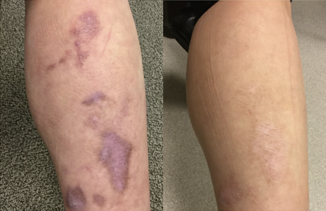 Laser Treatment Of Scars